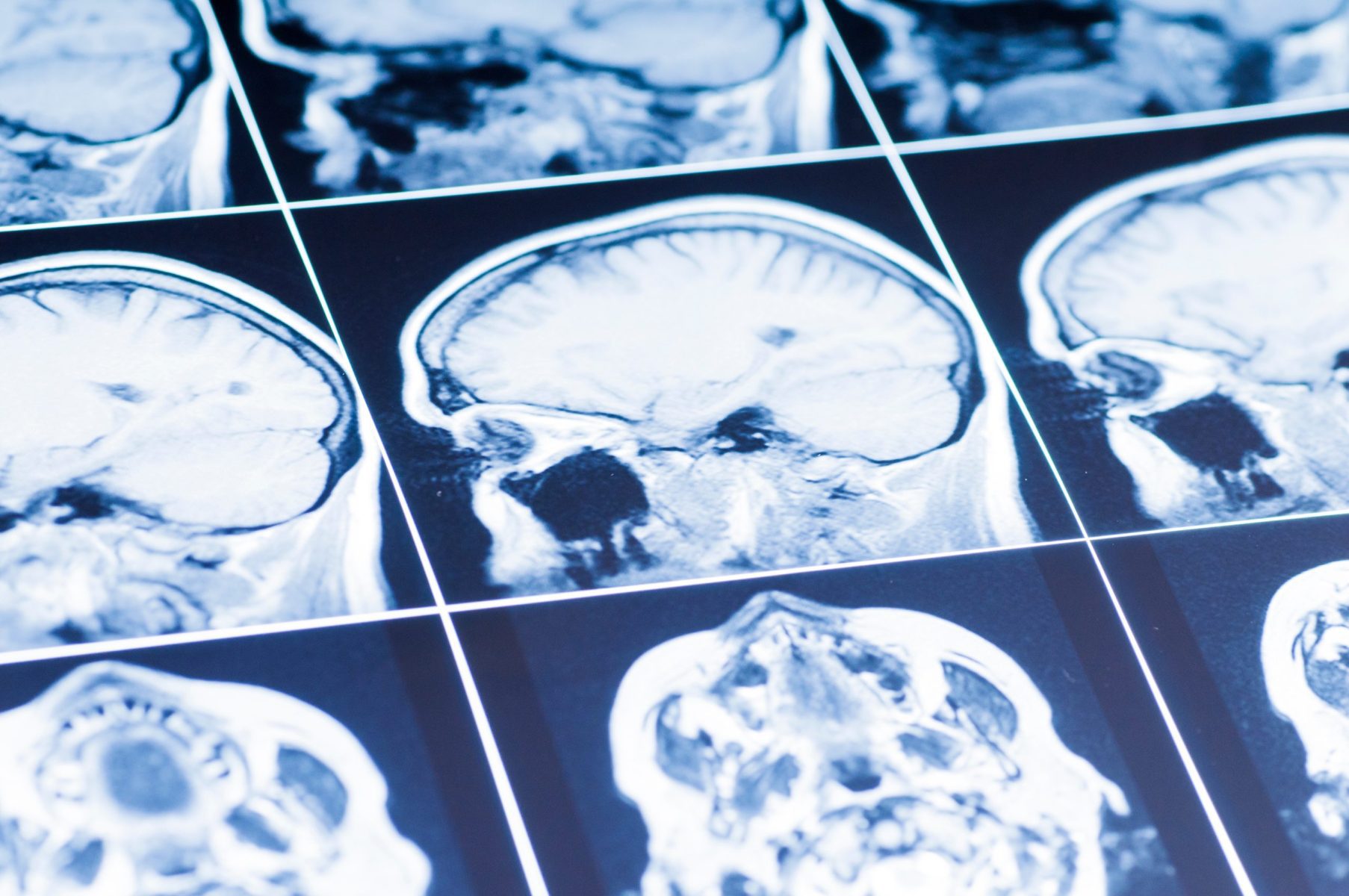 The compelling image of a brain scan serves as a powerful reminder of the importance of a personal injury attorney in Loves Park, who can offer specialized legal expertise and support in cases involving brain injuries and related claims.